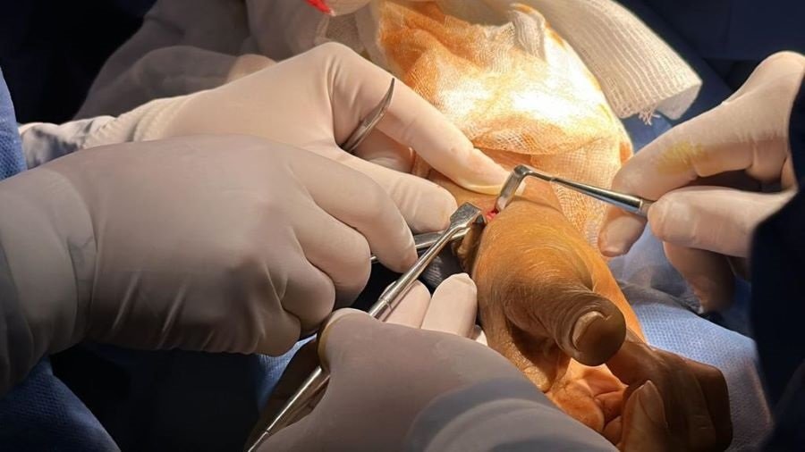 IMSS Hidalgo Realiza 42 procedimientos quirúrgicos en 37 pacientes  en las Jornadas de Cirugía plástica en HGZ No. 36 en Pachuca