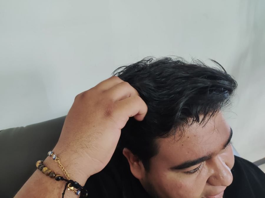 Ante la Temporada de Calor, SSH Advierte Sobre Brotes de Pediculosis (Piojos)