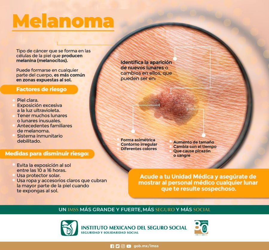 Recomienda IMSS Hidalgo Evitar Exposición Prolongada a Rayos Ultravioleta Para Prevenir Melanoma