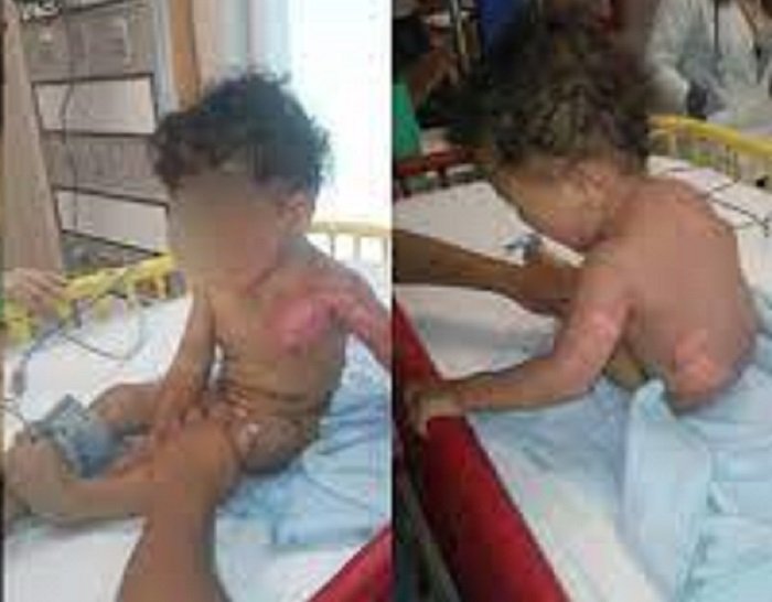 Dos Niños Sufrieron Quemaduras con Agua Hirviendo los Trasladan al Hospital del Niño DIF