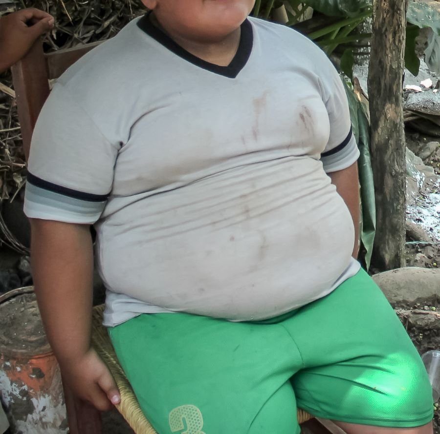 Identificados en Hidalgo, Más de 4 Mil Menores Con Sobrepeso y Obesidad Durante el Primer Semestre de 2023