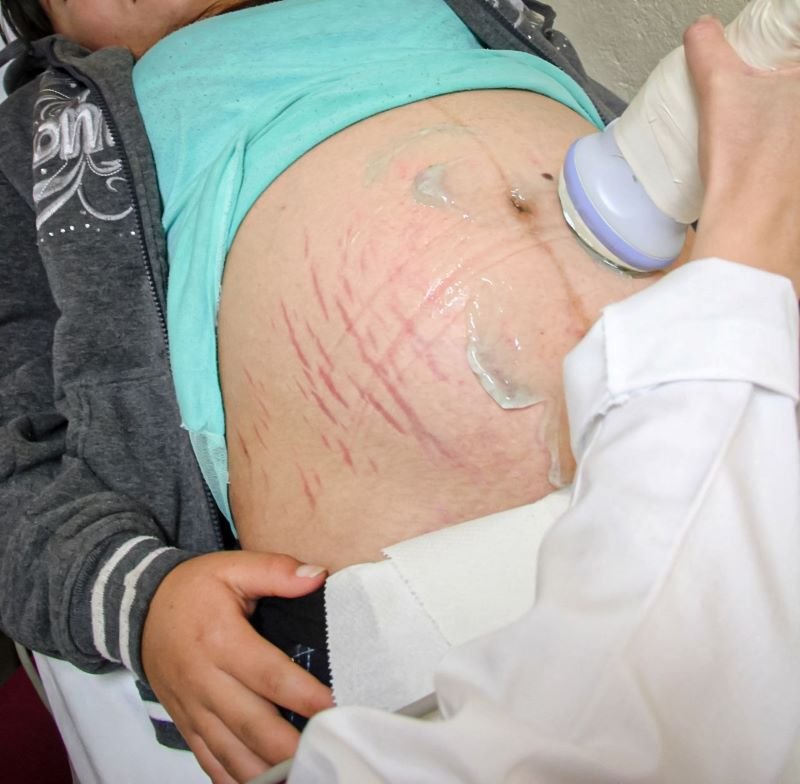 Para Evitar Partos Prematuros, SSH Promueve el Adecuado Control Prenatal