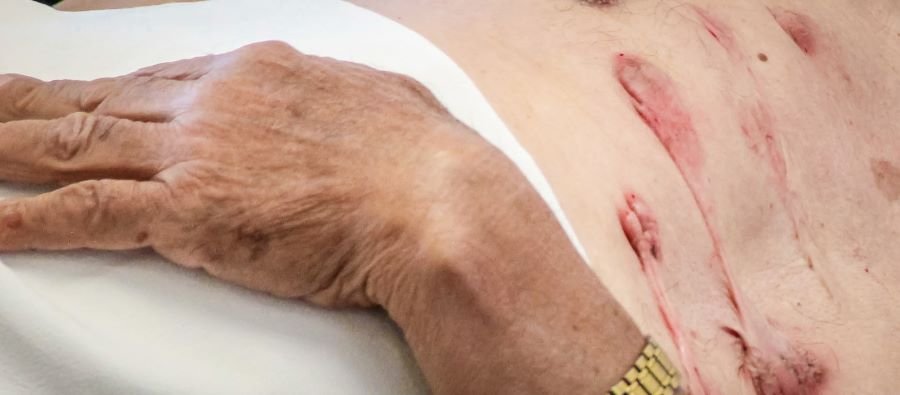 Hidalgo Mantienen Acciones Para Identificación y Diagnóstico de Casos de Lepra