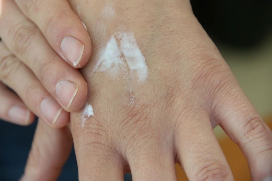 Advierten Sobre Riesgo Por Exposición a Radiación Solar