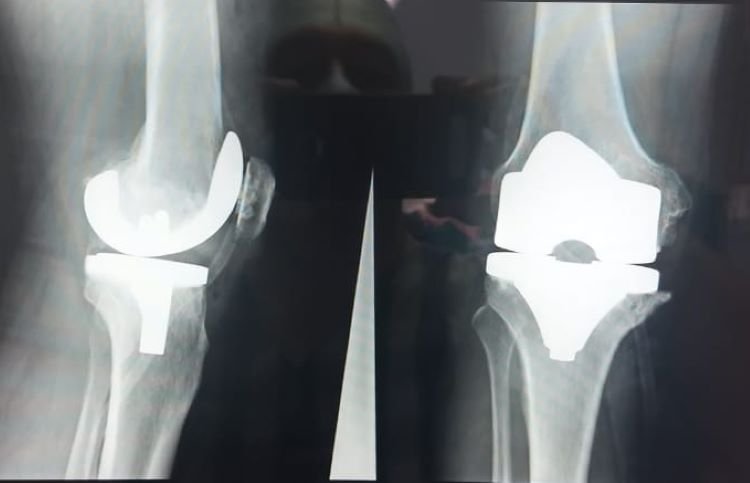 En Hidalgo se Mantiene Una Vigilancia Epidemiológica De Parálisis Flácida Aguda