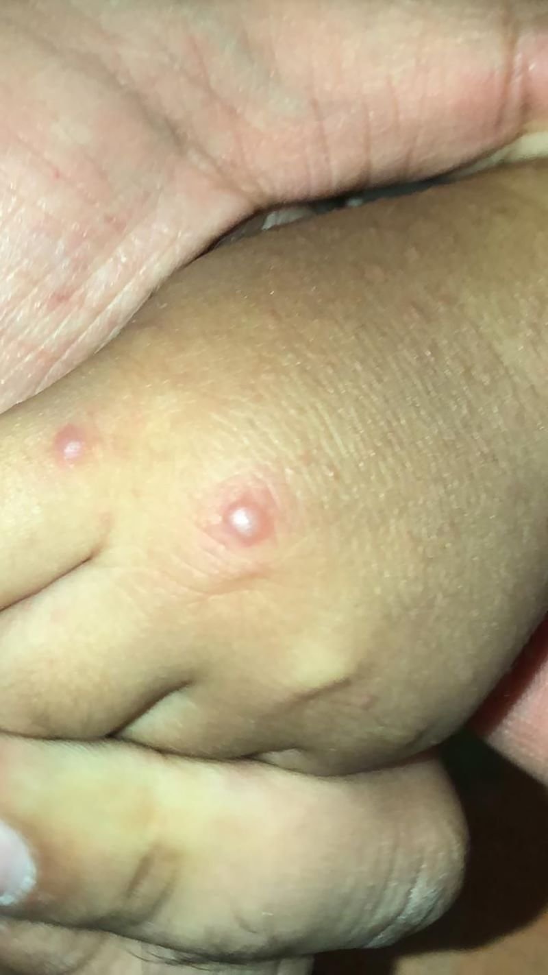 La Secretaría de Salud de Hidalgo confirmó 38 casos de Coxsackie en Tula.