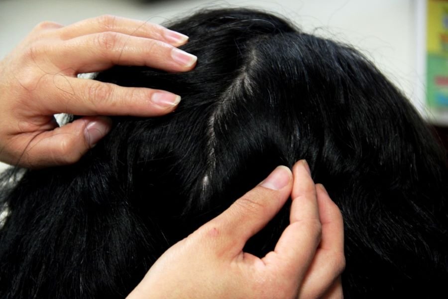 Panorama General de la Pediculosis en Hidalgo