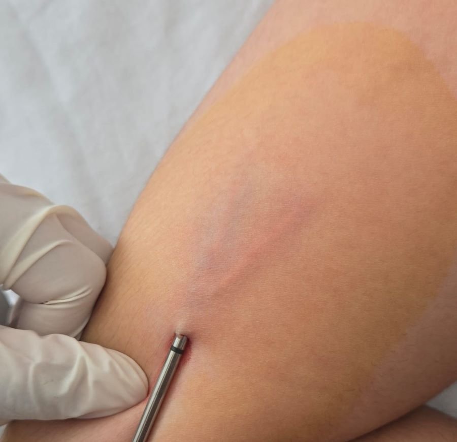 IMSS-Bienestar Hidalgo Amplía El Acceso Gratuito A La Salud Reproductiva Con Jornada De Colocación De Implante Subdérmico