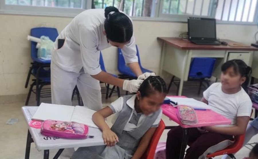 IMSS Bienestar Hidalgo Recomienda Acudir al Médico Ante La Sospecha de Pediculosis y Evitar Remedios Caseros