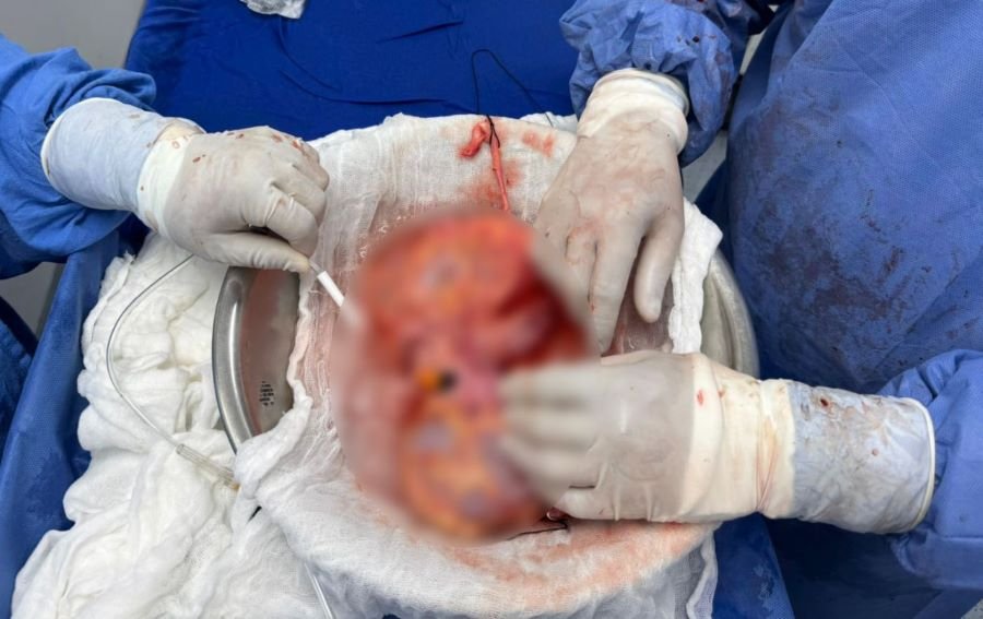 Realiza IMSS Hidalgo procuración de riñones en HGZ/FM No. 1 de Pachuca